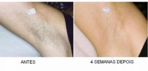Cuidados antes e após a depilação a laser